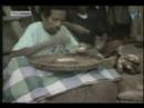 Spectacular case of elephantiasis